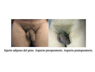Engrosamiento de pene antes y después - 797666