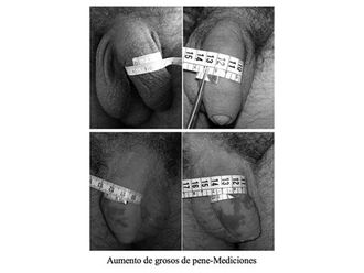 Engrosamiento de pene antes y después - 797667