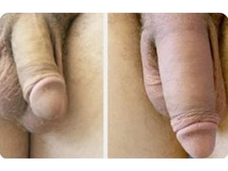 Alargamiento de pene antes y después - 808329