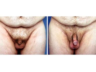 Alargamiento de pene antes y después - 812289