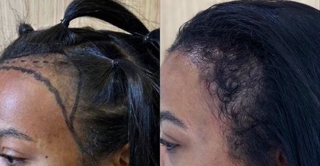 Antes y después de pérdida frontal femenina compatible con tracción, mejora tras Método Capilaris.