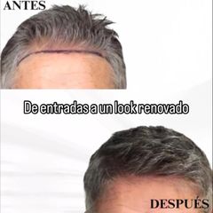 Técnica Zafiro: precisión máxima y recuperación rápida