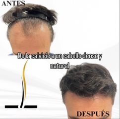 💎 Técnica Zafiro para máxima precisión