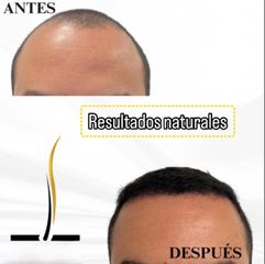 💎 Técnica Zafiro para resultados más precisos y cicatrización rápida.