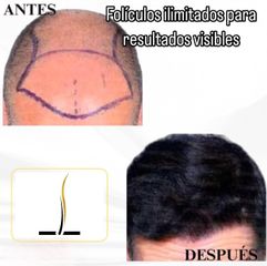 💎 Técnica Zafiro para resultados más precisos y cicatrización rápida.