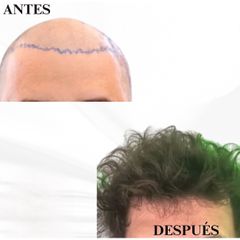 Transplante Capilar