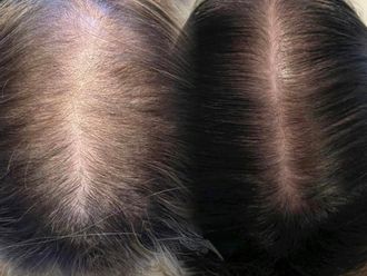 Mesoterapia capilar antes y después - 877604