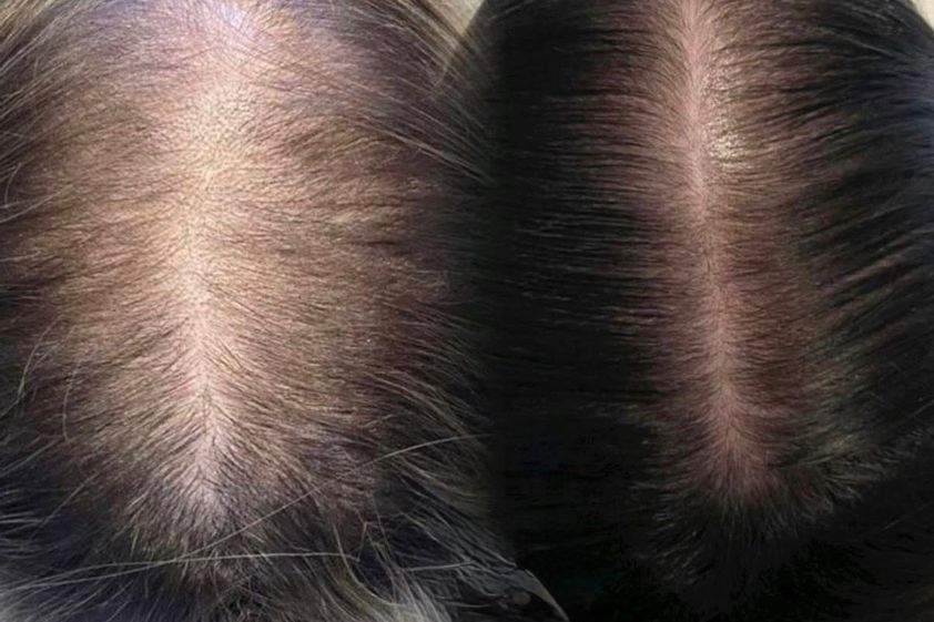 Mesoterapia capilar antes y después - 877604
