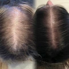 Alopecia femenina - Clínica Capilaris