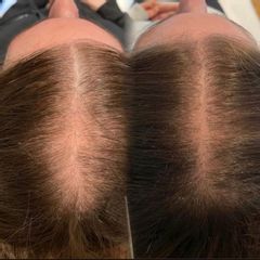 Alopecia femenina tratada con mesoterapia capilar- Clínica Capilaris