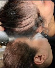 Alopecia Feminina - Clínica Capilaris