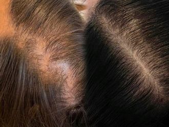 Tratamiento capilar antes y después - 877607