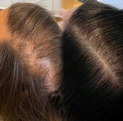 Alopecia Femenina - Clínica Capilaris