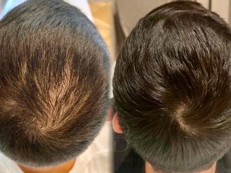 Tratamiento capilar antes y después - 877608