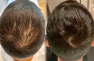 Alopecia Masculina - Clínica Capilaris