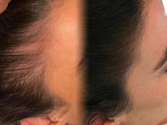 Tratamiento capilar antes y después - 877609