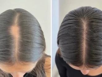 Tratamiento capilar antes y después - 880805
