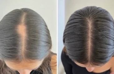 alopecia feminina