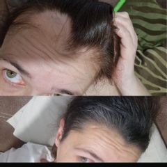 Alopecia feminina