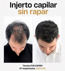 Trasplante capilar sin rapar