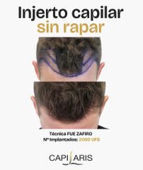 Injerto capilar sin rapar