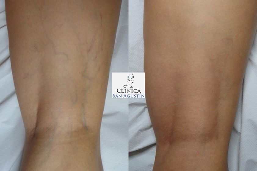 Tratamiento varices antes y después - 786880