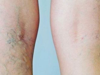 Tratamiento varices - 787015