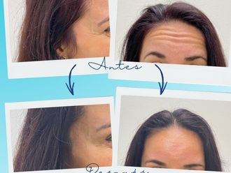 Eliminación arrugas antes y después - 877943