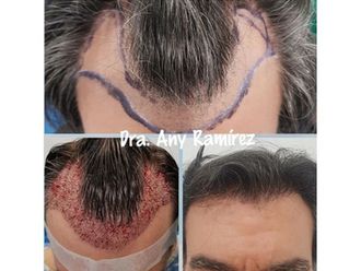 Trasplantes capilares - 650457