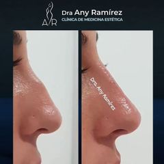 Rinomodelación - Dra. Any Ramírez
