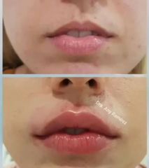 Aumento de labios - Dra. Any Ramírez