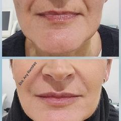 Aumento de labios - Dra. Any Ramírez