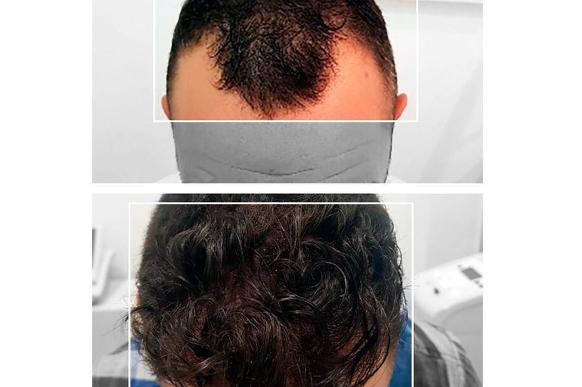 Alopecia antes y después - 855558