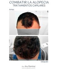 Alopecia - Dra. Any Ramírez