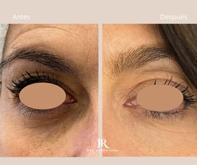 Eliminaciónn de ojeras - Dra. Juana Rosa