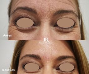 Eliminación de ojeras - Dra. Juana Rosa