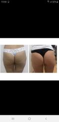Antes y después tratamiento celulitis