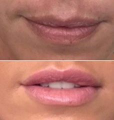 Antes y después Aumento de labios con ácido hialurónico indicado para la zona.