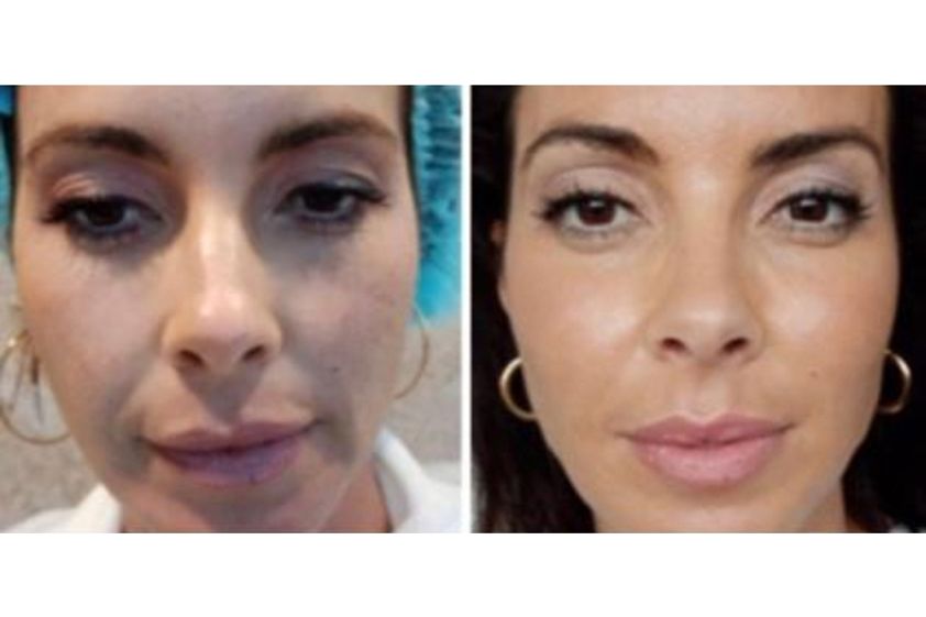 Hilos tensores antes y después - 699153