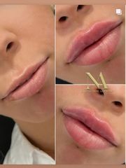 Aumento de labios - Clínica Loveliness