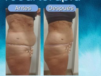 HIFU antes y después - 845125