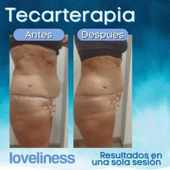 Tecarterapia - Clínica Loveliness