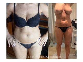 Antes y después Liposucción - Dra. Celia Farres Puiguriguer