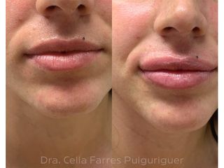 Antes y después Aumento de labios - Dra. Celia Farres Puiguriguer