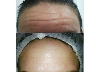Botox en arrugas frontales. Tratamiento realizado por la Dra. Mariela Barroso