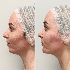 Rellenos faciales - Dra. Mariela Barroso - Clínica Reabel