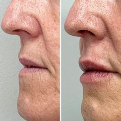 Aumento de labios - Dra. Mariela Barroso - Clínica Reabel