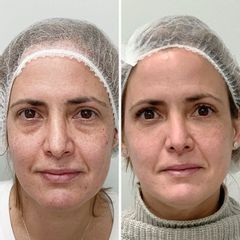 Eliminación de ojeras - Dra. Mariela Barroso - Clínica Reabel