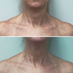 Rejuvenecimiento de cuello - Dra. Mariela Barroso - Clínica Reabel