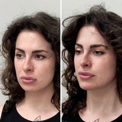 Armonización Facial - Clínica Reabel - Dra. Mariela Barroso